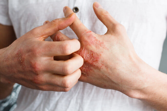 Tired of that Eczema Rash Always Flaring Up?